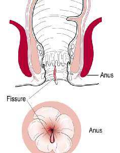 Anal Fissure.png