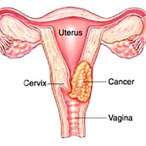 Cervical Cancer.jpg