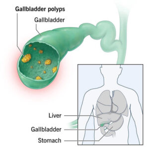 Gallbladder Polyp.jpg