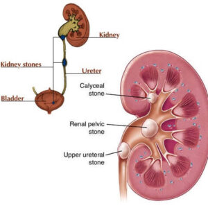 Kidney Stone.jpg