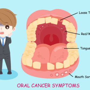 Man With Oral Cancer Symptoms On The Blue Background