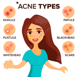 Acne Pimple