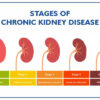 Chronic Kidney Ddisease