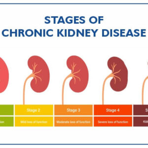 Chronic Kidney Ddisease