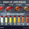 Liver Disease Failure