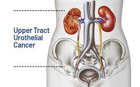 Urothelial Cancer