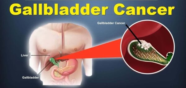Gall Bladder Cancer